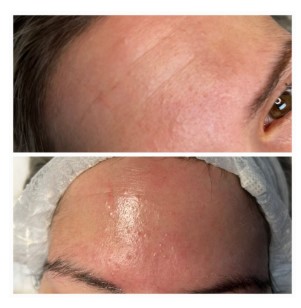 Dermapen tretman